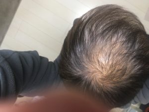 男性型脱毛症 Aga の基準と原因そして治し方実践記 ミカミケイマ Fpです